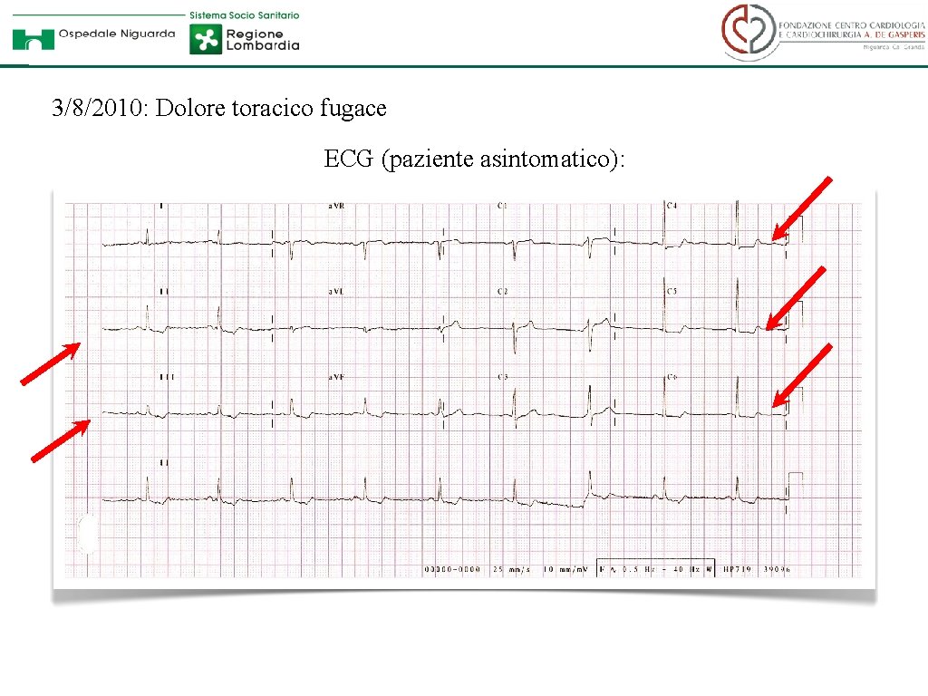 3/8/2010: Dolore toracico fugace ECG (paziente asintomatico): 