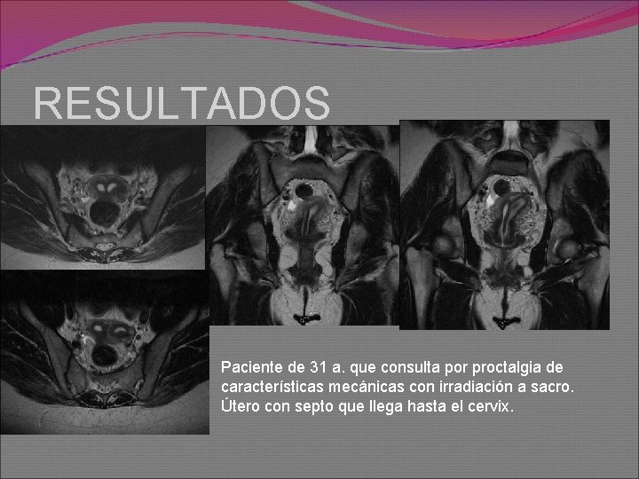 RESULTADOS Paciente de 31 a. que consulta por proctalgia de características mecánicas con irradiación