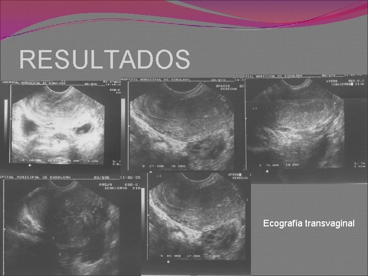 RESULTADOS Ecografía transvaginal 