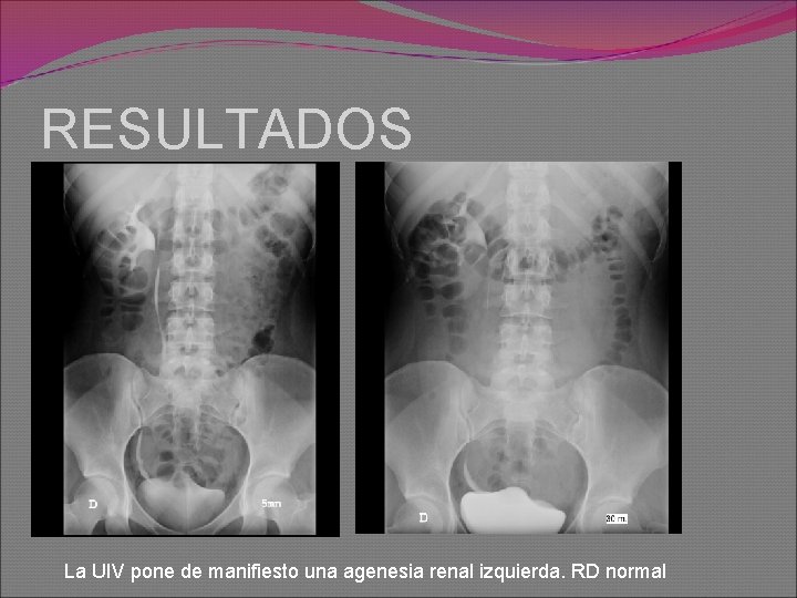 RESULTADOS La UIV pone de manifiesto una agenesia renal izquierda. RD normal 