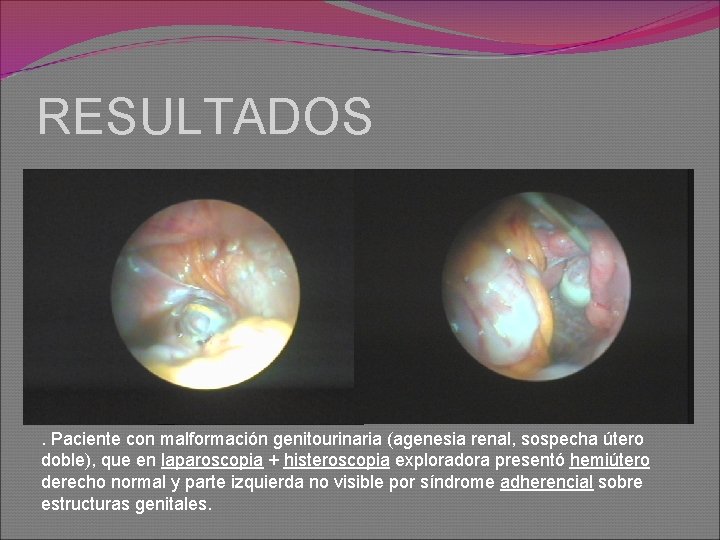 RESULTADOS . Paciente con malformación genitourinaria (agenesia renal, sospecha útero doble), que en laparoscopia