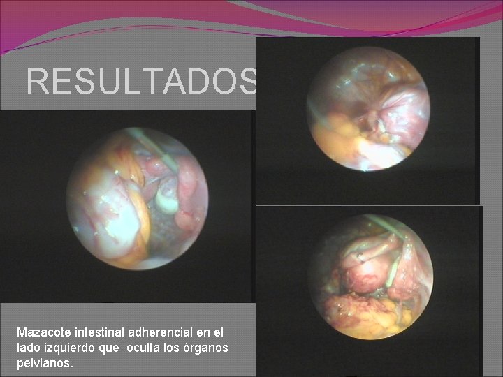 RESULTADOS Mazacote intestinal adherencial en el lado izquierdo que oculta los órganos pelvianos. 