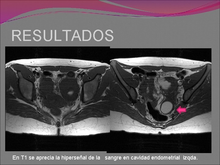 RESULTADOS En T 1 se aprecia la hiperseñal de la sangre en cavidad endometrial