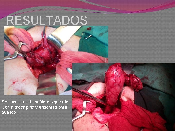 RESULTADOS Se localiza el hemiútero izquierdo Con hidrosalpinx y endometrioma ovárico 