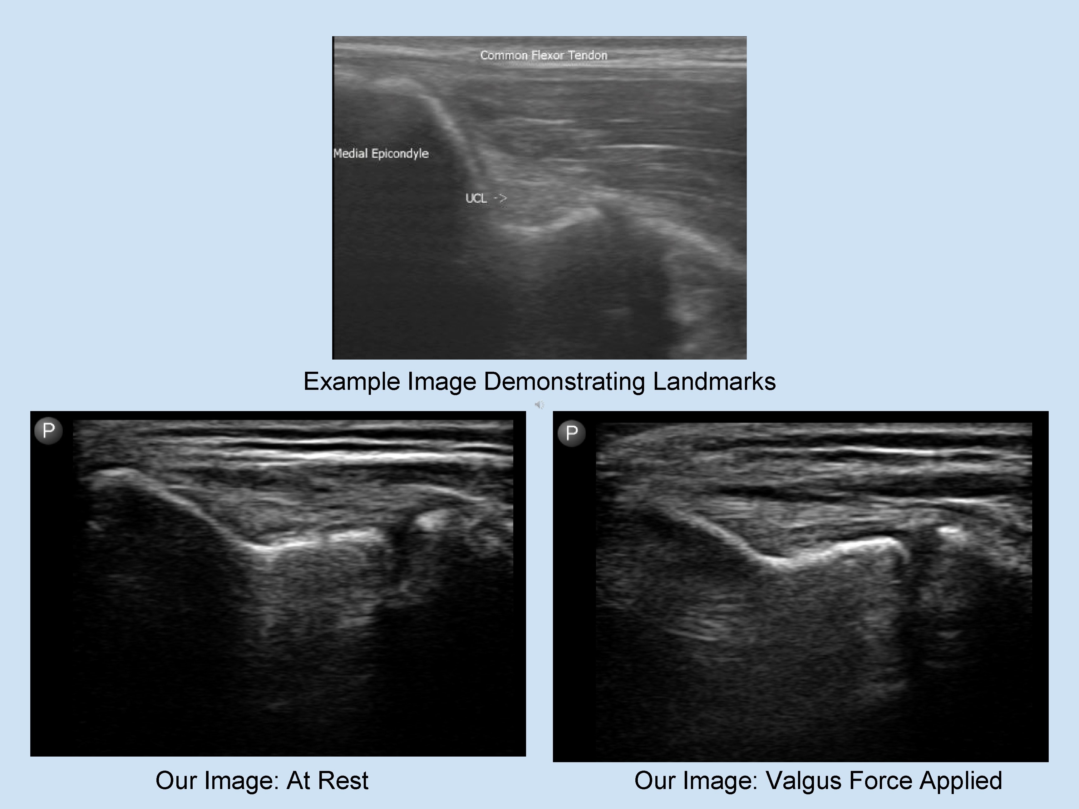 Example Image Demonstrating Landmarks Our Image: At Rest Our Image: Valgus Force Applied 