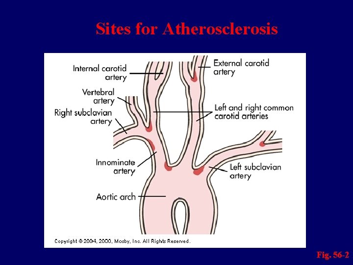 Sites for Atherosclerosis Fig. 56 -2 