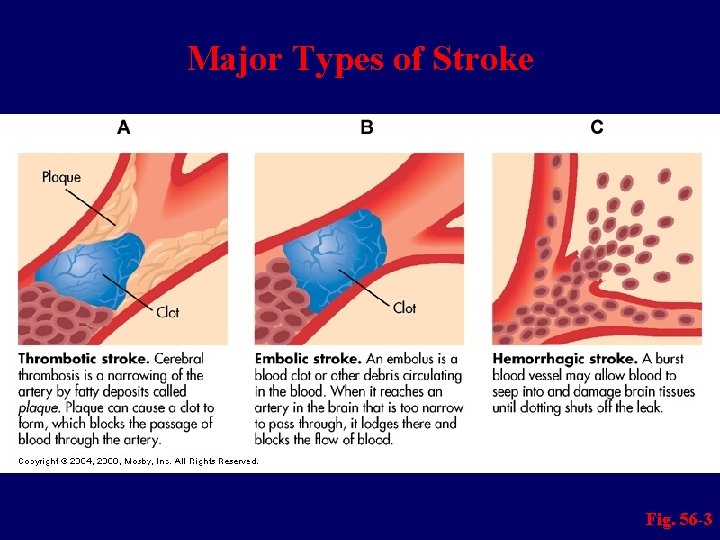 Major Types of Stroke Fig. 56 -3 