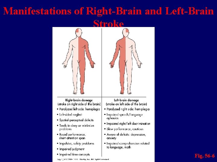 Manifestations of Right-Brain and Left-Brain Stroke Fig. 56 -6 