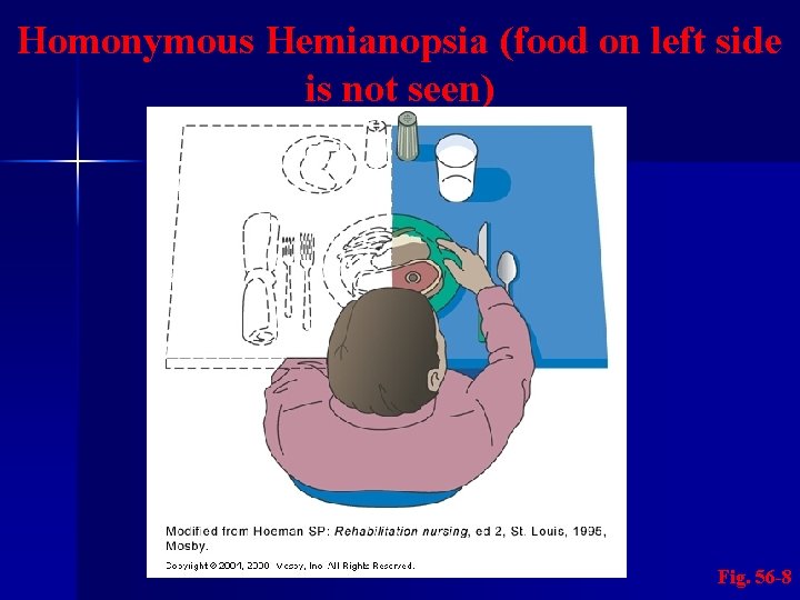 Homonymous Hemianopsia (food on left side is not seen) Fig. 56 -8 