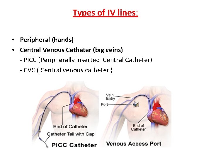 Types of IV lines; • Peripheral (hands) • Central Venous Catheter (big veins) -