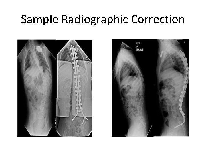 Sample Radiographic Correction 