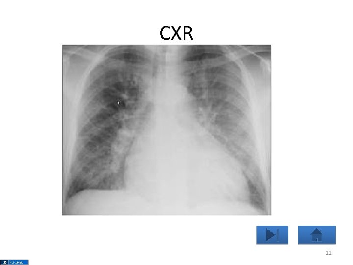 CXR 11 