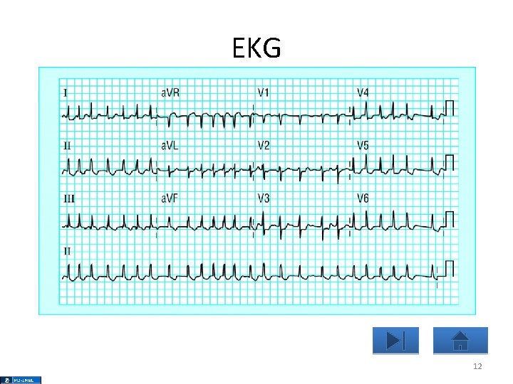 EKG 12 