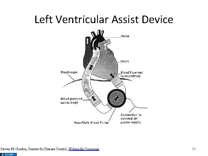 Left Ventricular Assist Device Steven M. Gordon, Centers for Disease Control, Wikimedia Commons 33