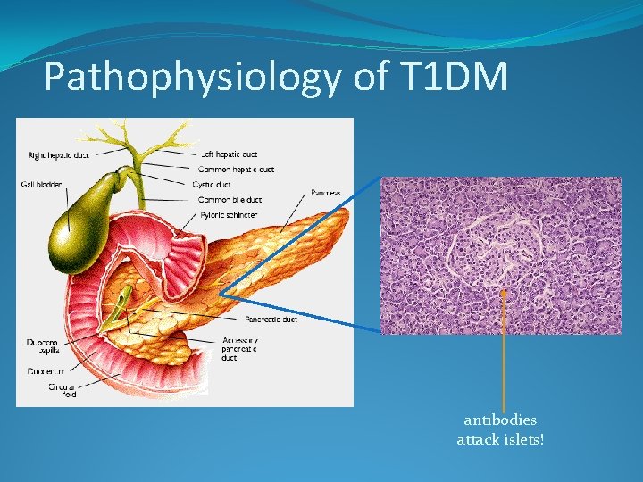 Pathophysiology of T 1 DM antibodies attack islets! 