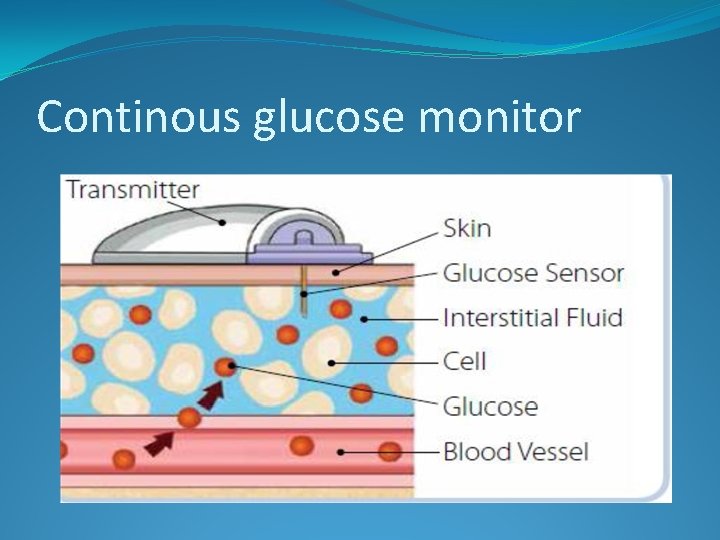 Continous glucose monitor 