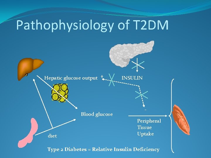 Pathophysiology of T 2 DM Hepatic glucose output + Blood glucose diet INSULIN Peripheral