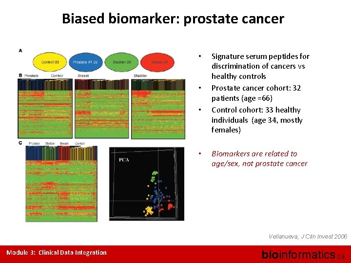 Biased biomarker: prostate cancer • • Signature serum peptides for discrimination of cancers vs