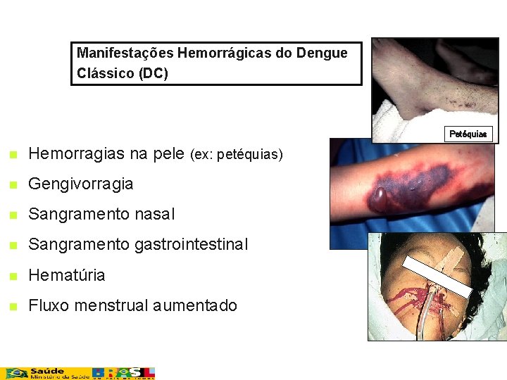Manifestações Hemorrágicas do Dengue Clássico (DC) Petéquias n Hemorragias na pele (ex: petéquias) n