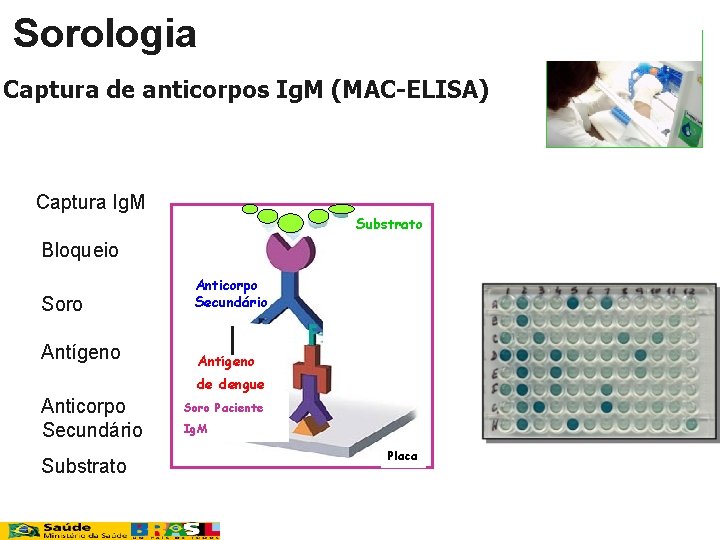 Sorologia Captura de anticorpos Ig. M (MAC-ELISA) 1 Captura Ig. M Substrato 2. Bloqueio