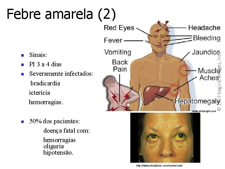 Febre amarela (2) n n n Sinais: PI 3 a 4 dias Severamente infectados: