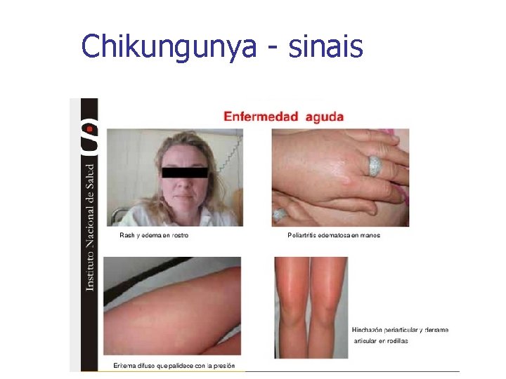 Chikungunya - sinais 