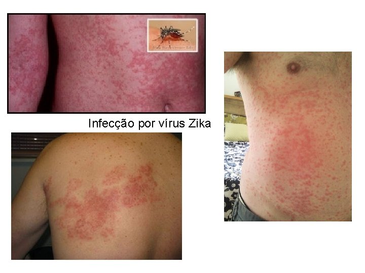 Infecção por vírus Zika 