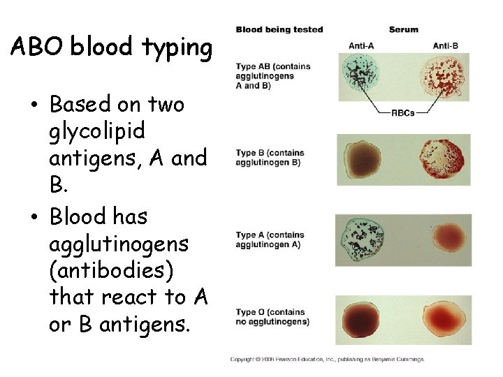 ABO blood typing • Based on two glycolipid antigens, A and B. • Blood