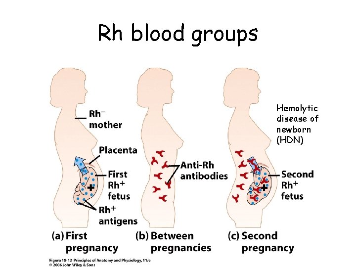 Rh blood groups Hemolytic disease of newborn (HDN) 