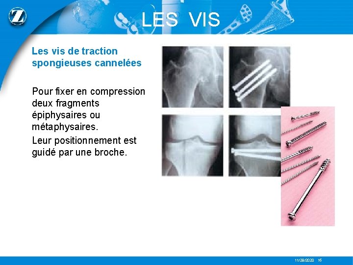 LES VIS Les vis de traction spongieuses cannelées Pour fixer en compression deux fragments