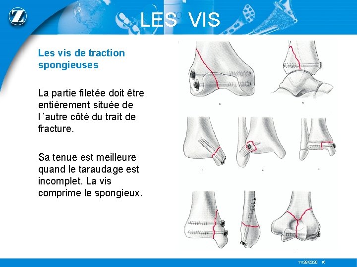 LES VIS Les vis de traction spongieuses La partie filetée doit être entièrement située