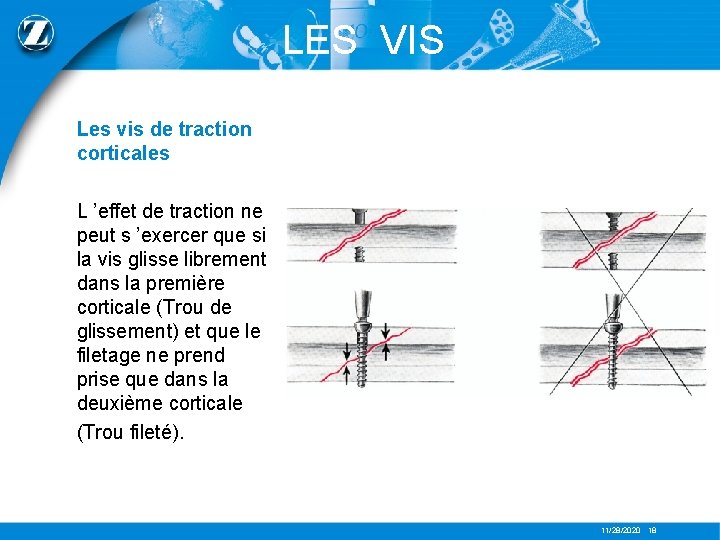 LES VIS Les vis de traction corticales L ’effet de traction ne peut s