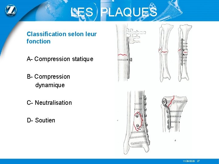 LES PLAQUES Classification selon leur fonction A- Compression statique B- Compression dynamique C- Neutralisation