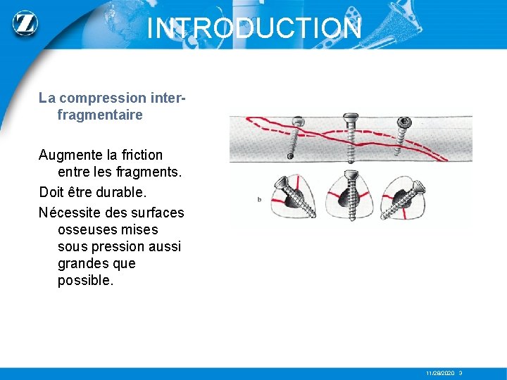 INTRODUCTION La compression interfragmentaire Augmente la friction entre les fragments. Doit être durable. Nécessite