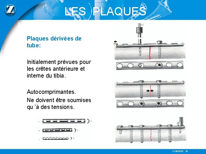 LES PLAQUES Plaques dérivées de tube: Initialement prévues pour les crêtes antérieure et interne
