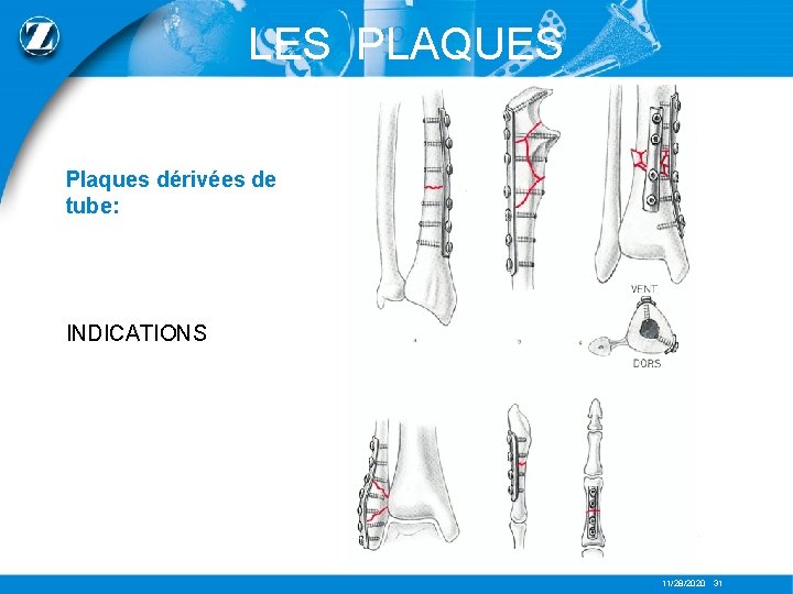 LES PLAQUES Plaques dérivées de tube: INDICATIONS 11/28/2020 31 
