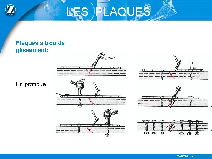 LES PLAQUES Plaques à trou de glissement: En pratique 11/28/2020 34 