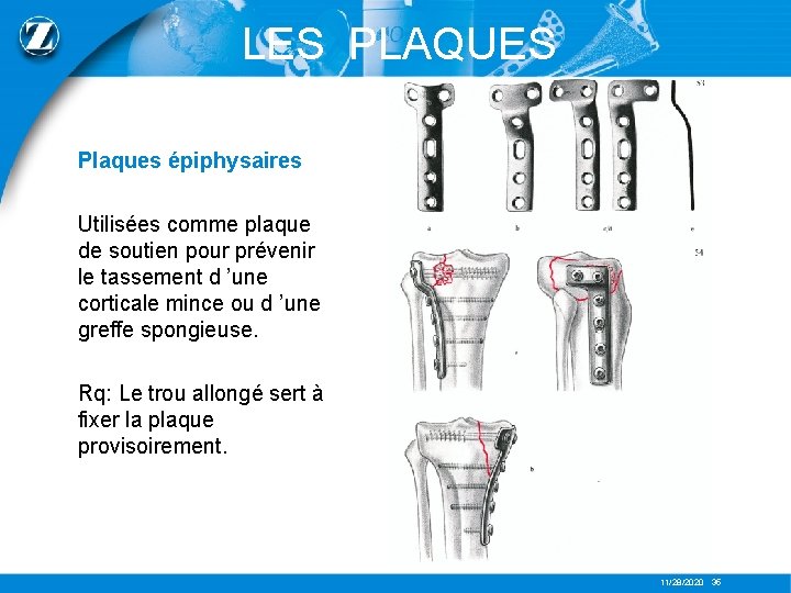 LES PLAQUES Plaques épiphysaires Utilisées comme plaque de soutien pour prévenir le tassement d