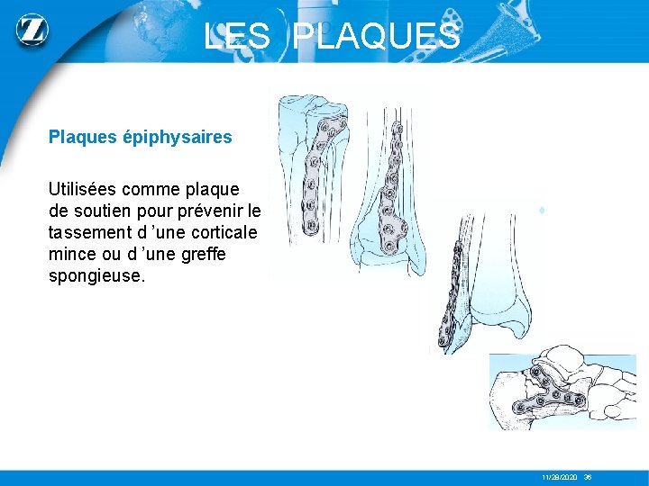 LES PLAQUES Plaques épiphysaires Utilisées comme plaque de soutien pour prévenir le tassement d