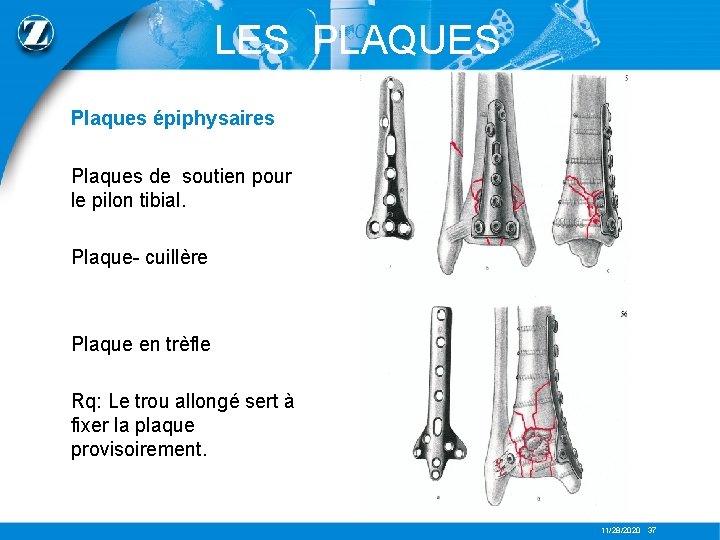 LES PLAQUES Plaques épiphysaires Plaques de soutien pour le pilon tibial. Plaque- cuillère Plaque