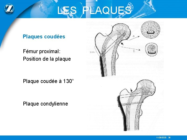 LES PLAQUES Plaques coudées Fémur proximal: Position de la plaque Plaque coudée à 130°