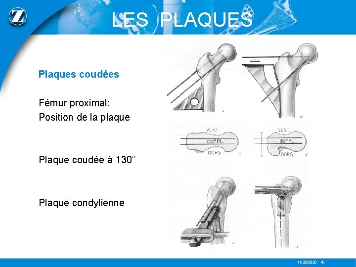 LES PLAQUES Plaques coudées Fémur proximal: Position de la plaque Plaque coudée à 130°