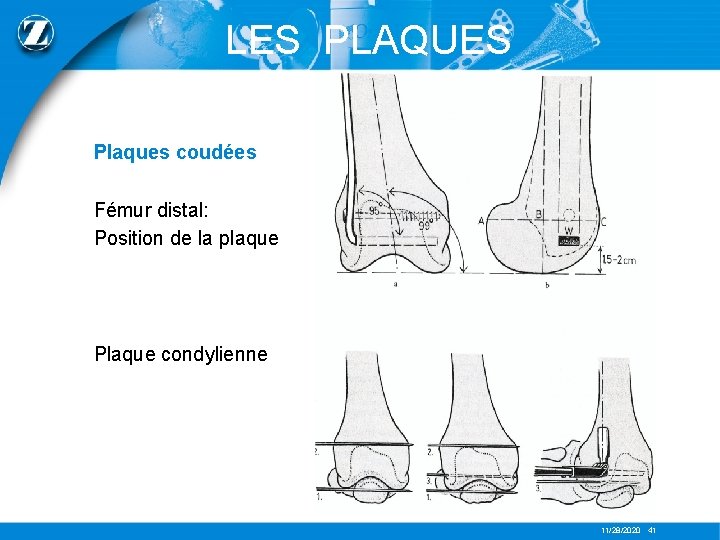 LES PLAQUES Plaques coudées Fémur distal: Position de la plaque Plaque condylienne 11/28/2020 41