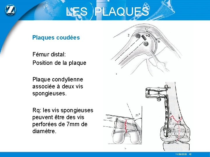 LES PLAQUES Plaques coudées Fémur distal: Position de la plaque Plaque condylienne associée à
