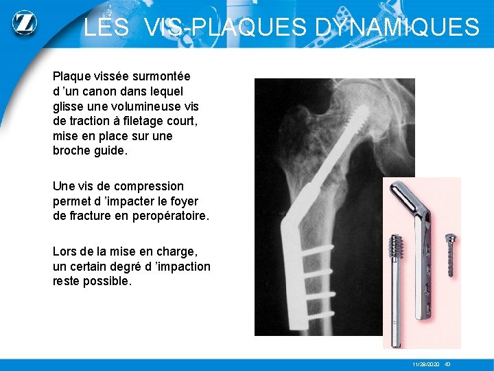 LES VIS-PLAQUES DYNAMIQUES Plaque vissée surmontée d ’un canon dans lequel glisse une volumineuse