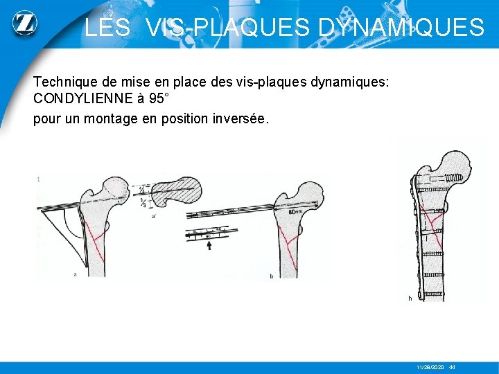LES VIS-PLAQUES DYNAMIQUES Technique de mise en place des vis-plaques dynamiques: CONDYLIENNE à 95°