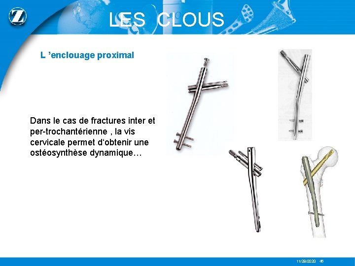 LES CLOUS L ’enclouage proximal Dans le cas de fractures inter et per-trochantérienne ,