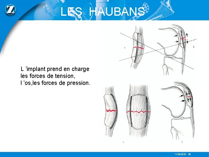 LES HAUBANS L ’implant prend en charge les forces de tension, l ’os, les