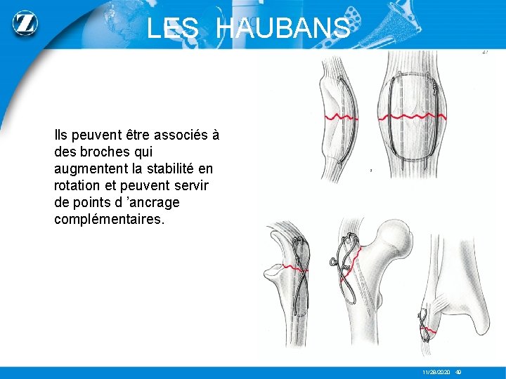 LES HAUBANS Ils peuvent être associés à des broches qui augmentent la stabilité en