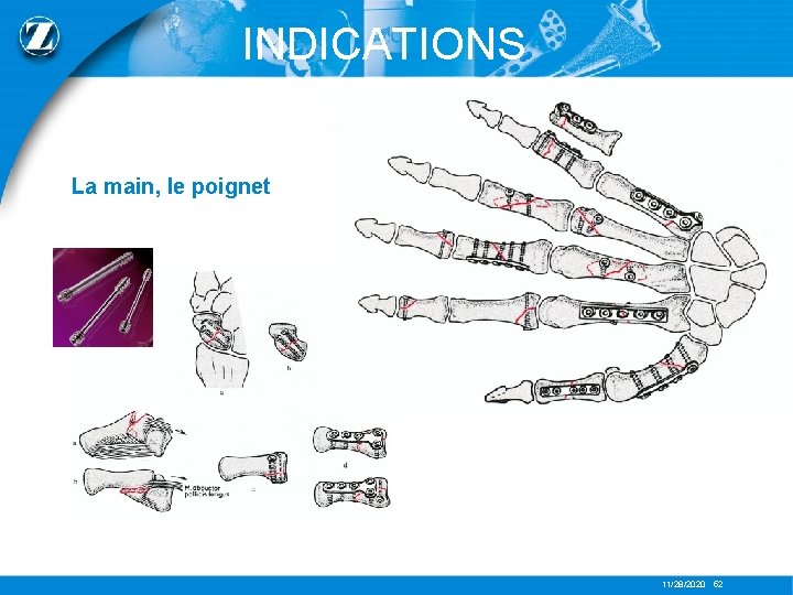 INDICATIONS La main, le poignet 11/28/2020 52 
